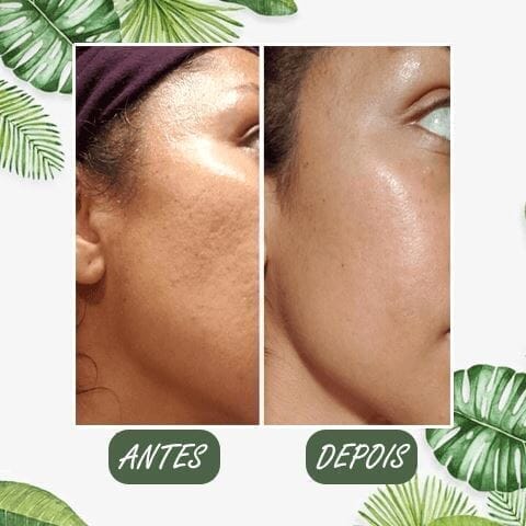 Máscara De Chá Verde Remover Cravos Anti-Acne